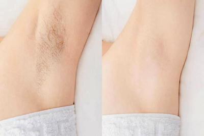 郑州科大医院腋臭专科:除臭就要与众不同