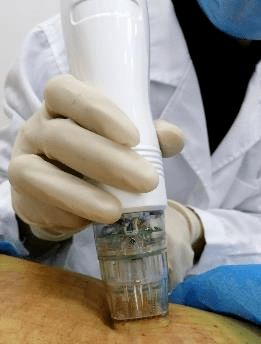 腋臭治疗 宝点 ,两袖清风不是梦