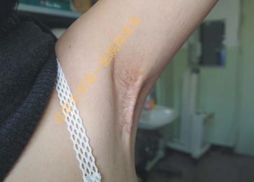 扫除一生的烦恼 微创腋臭根治术