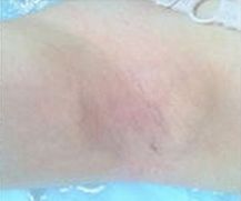 怎么治疗狐臭好