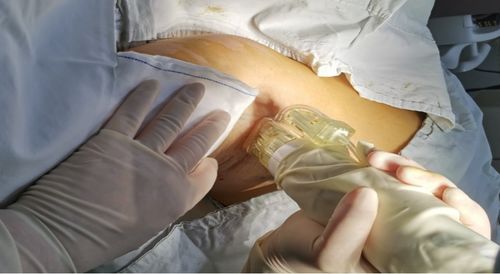 黄金微针治疗腋臭,您了解吗