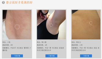 青岛治疗狐臭指南 方法与机构推荐