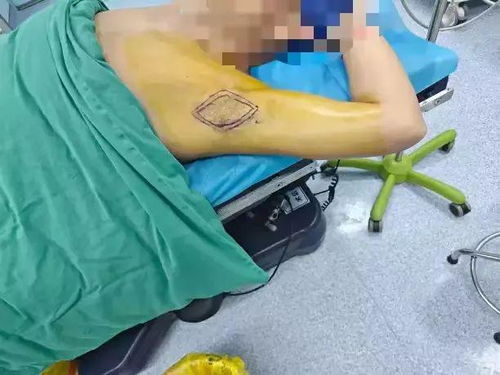 摆脱腋臭困扰 全面了解与有效应对狐臭的策略